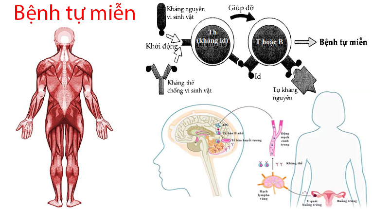 Rối loạn tự miễn dịch với nghiên cứu cập nhật