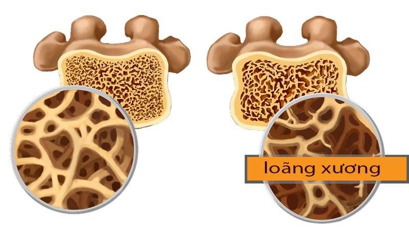 Loãng xương và các phương pháp chẩn đoán