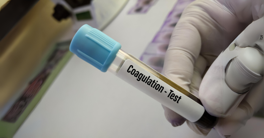 Bàn tay đeo găng cầm ống máu nắp xanh ghi nhãn "Coagulation - Test" (xét nghiệm đông máu)