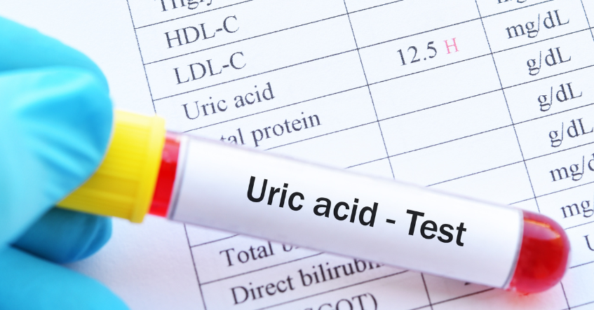 Ống máu ghi nhãn "Uric acid - Test" trên phiếu kết quả xét nghiệm