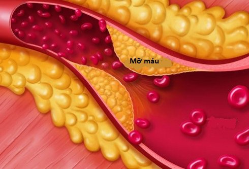 Hình minh họa mảng mỡ máu bám trong lòng động mạch làm hẹp dòng máu