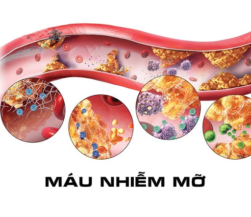 Hình minh họa máu nhiễm mỡ với các mảng mỡ bám trong thành mạch máu